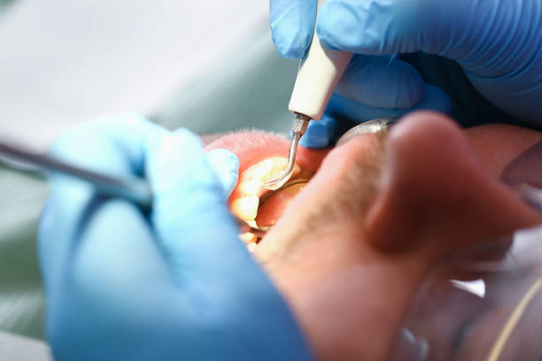 Best Emergency Wisdom Tooth Extraction in Brisbane, CA