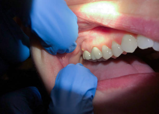 Best Broken or Chipped Tooth Repair in Brisbane, CA