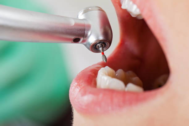 Best Emergency Root Canal Therapy in Brisbane, CA